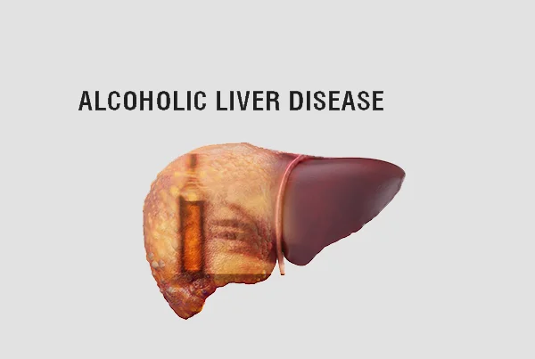 Alcoholic Liver Disease