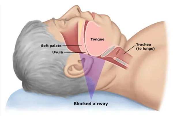 Sleep Apnea