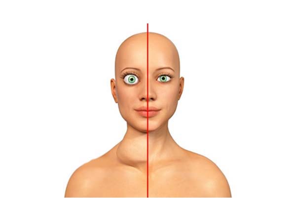 Graves Disease