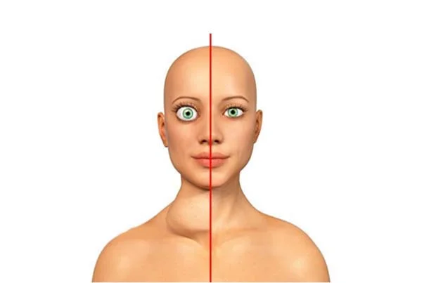 Graves Disease